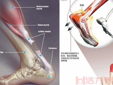 跑步跟腱疼要多久能好？